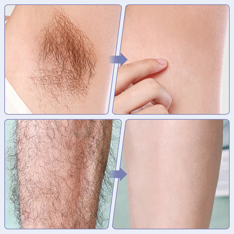 Laser IPL Hair Removal Device With Ice-Cooling Contact